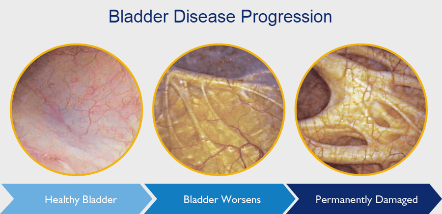Bladder Disease Progression2