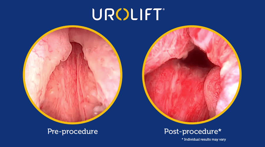 pre-post-procedure-typical